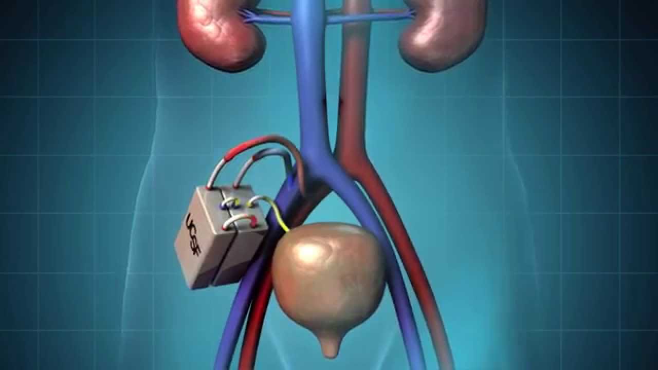 The Kidney Project Implantable Kidney The Proactive Path